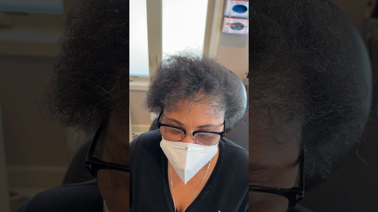 female patient's neograft interview