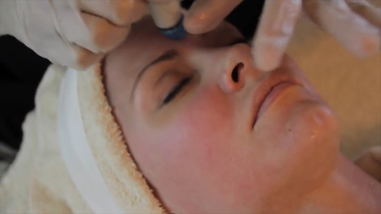 hydrafacial video screenshot