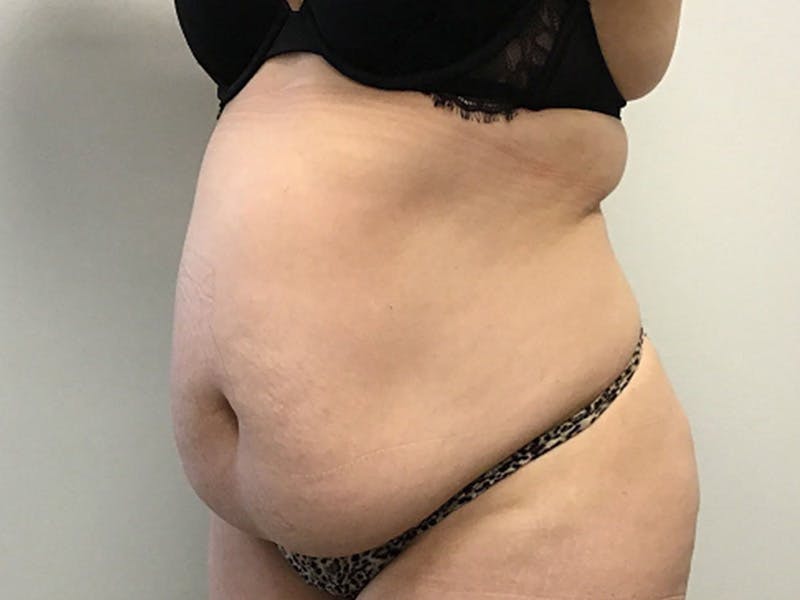 Body Jet Smartlipo Before & After Gallery - Patient 277552 - Image 1