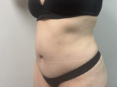 Body Jet Smartlipo Before & After Gallery - Patient 277552 - Image 2