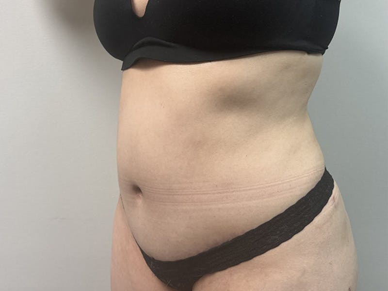 Body Jet Smartlipo Before & After Gallery - Patient 277552 - Image 2