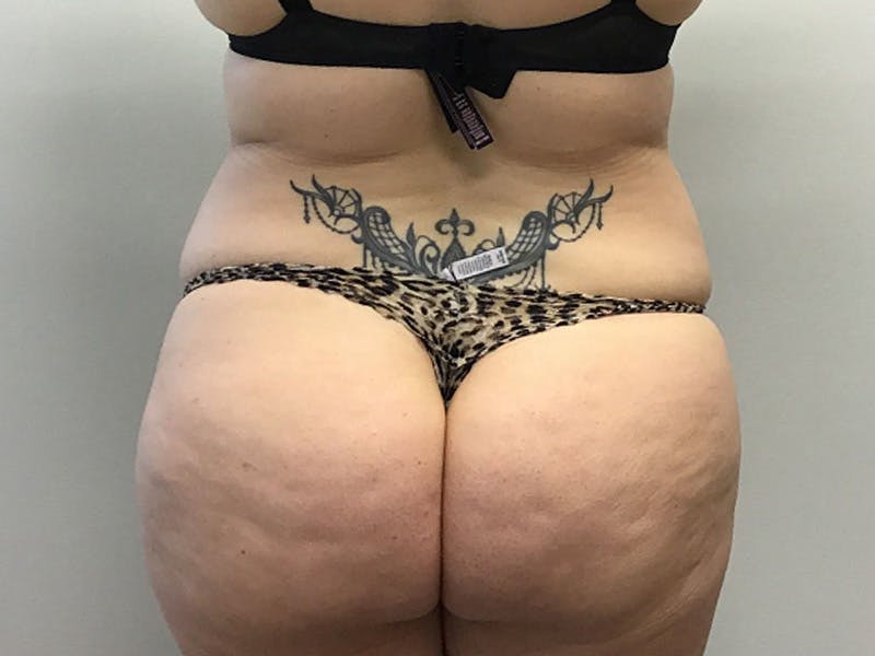 Body Jet Smartlipo Before & After Gallery - Patient 277552 - Image 3