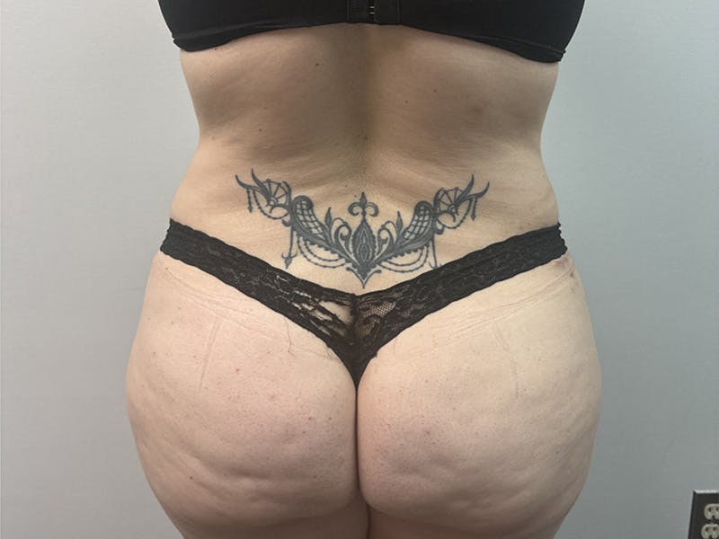 Body Jet Smartlipo Before & After Gallery - Patient 277552 - Image 4