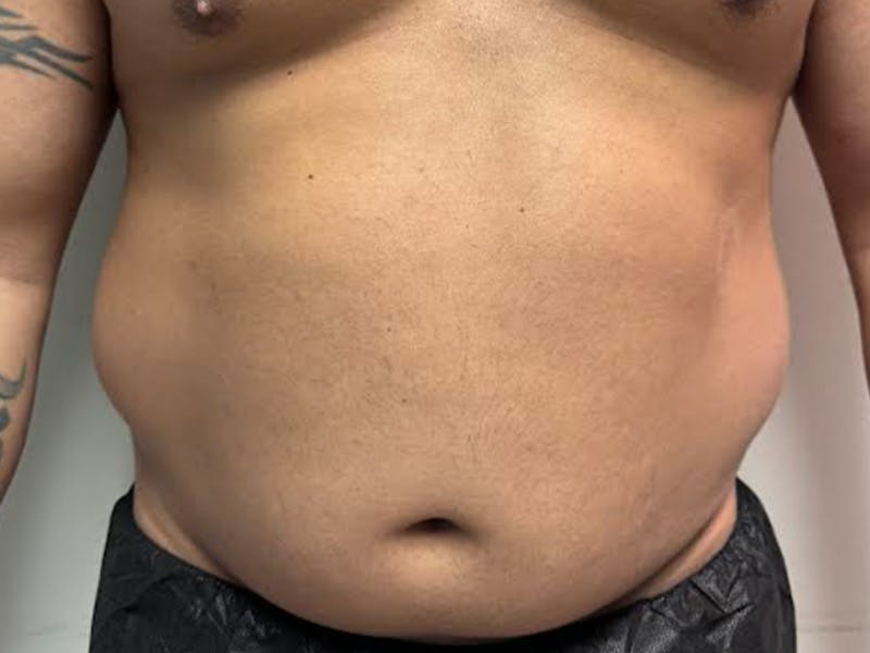 Body Jet Smartlipo Before & After Gallery - Patient 502751 - Image 1