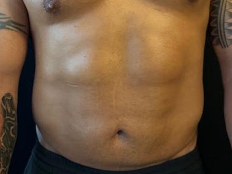 Body Jet Smartlipo Before & After Gallery - Patient 502751 - Image 2