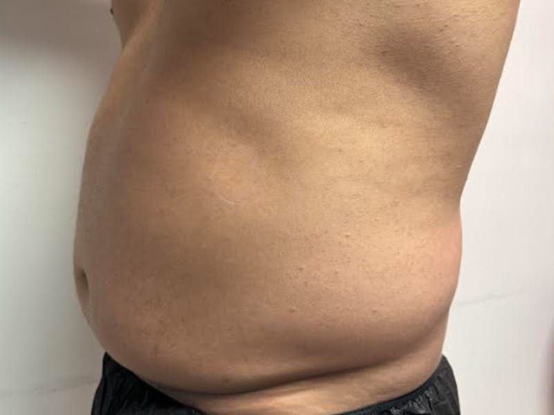 Body Jet Smartlipo Before & After Gallery - Patient 502751 - Image 3