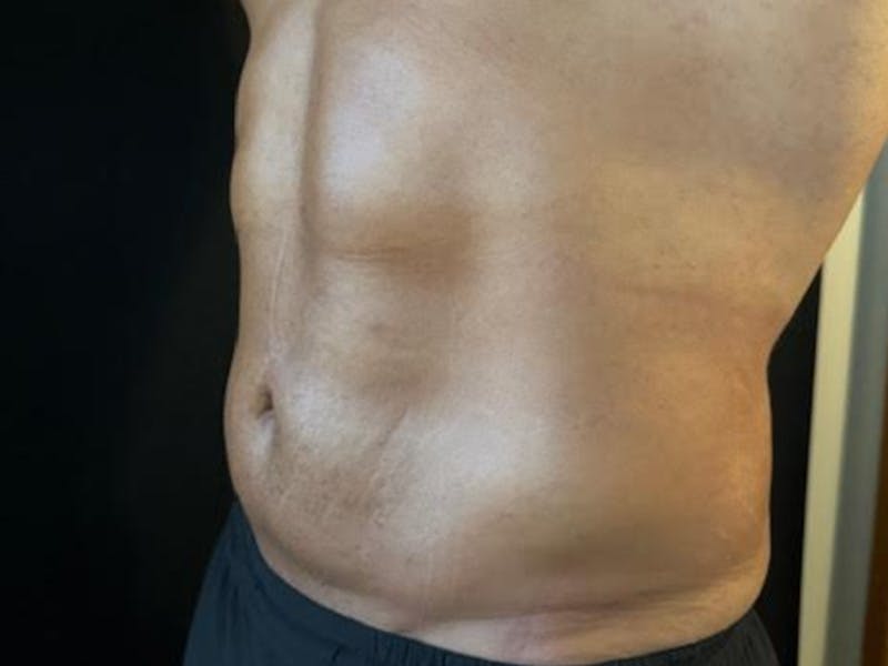 Body Jet Smartlipo Before & After Gallery - Patient 502751 - Image 4