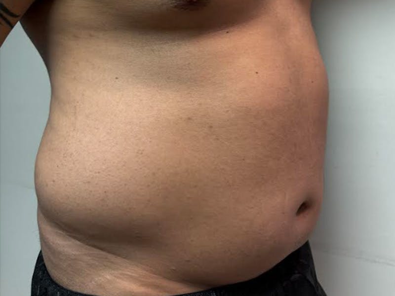 Body Jet Smartlipo Before & After Gallery - Patient 502751 - Image 5