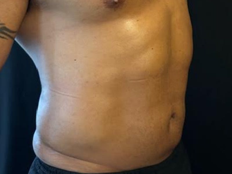 Body Jet Smartlipo Before & After Gallery - Patient 502751 - Image 6