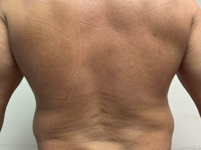 Body Jet Smartlipo Before & After Gallery - Patient 502751 - Image 7