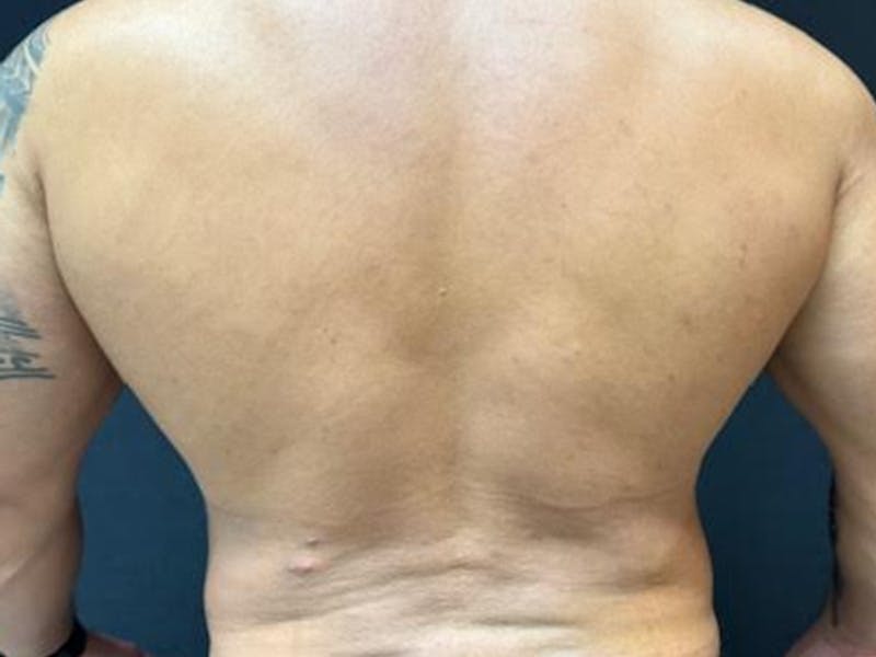 Body Jet Smartlipo Before & After Gallery - Patient 502751 - Image 8