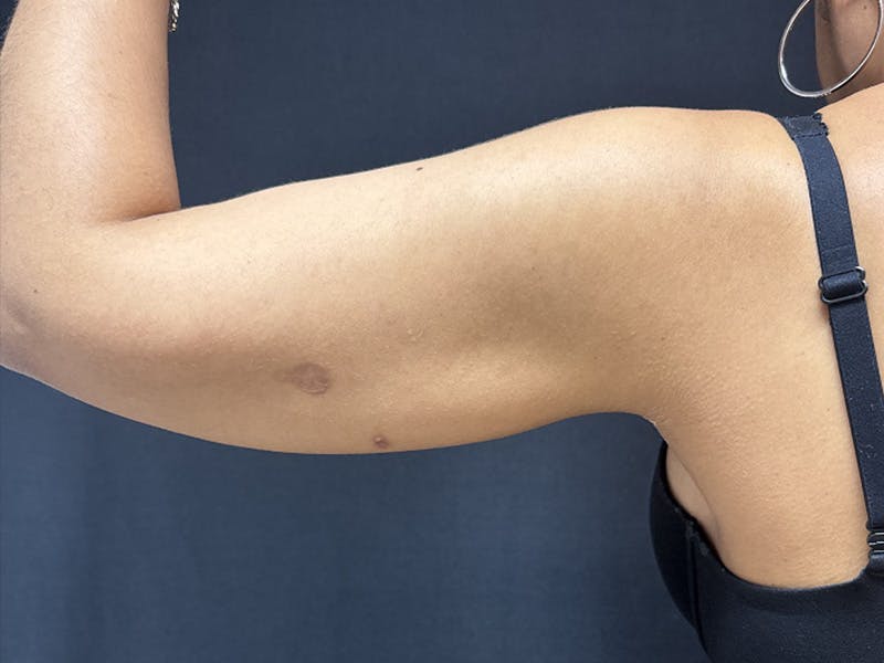 Body Jet Smartlipo Before & After Gallery - Patient 106670 - Image 1