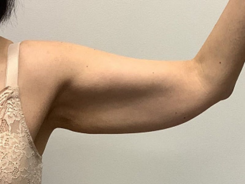 Tummy Tuck Before & After Gallery - Patient 332838 - Image 3