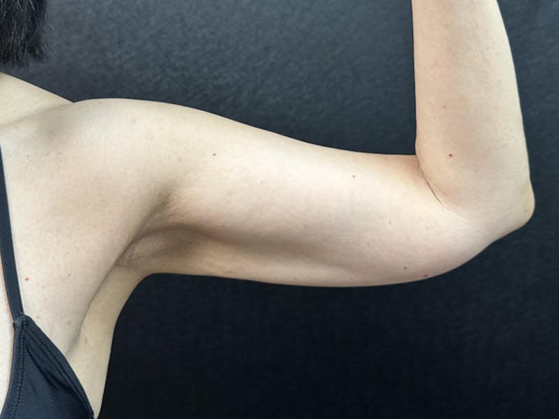 Tummy Tuck Before & After Gallery - Patient 332838 - Image 4