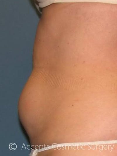 Body Jet Smartlipo Before & After Gallery - Patient 320170 - Image 1