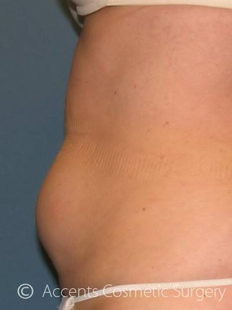 Body Jet Smartlipo Before & After Gallery - Patient 320170 - Image 1