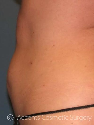 Body Jet Smartlipo Before & After Gallery - Patient 320170 - Image 2