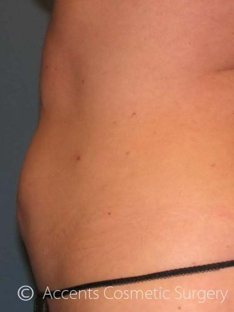Body Jet Smartlipo Before & After Gallery - Patient 320170 - Image 2
