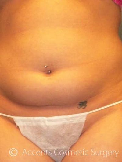 Body Jet Smartlipo Before & After Gallery - Patient 111511 - Image 1