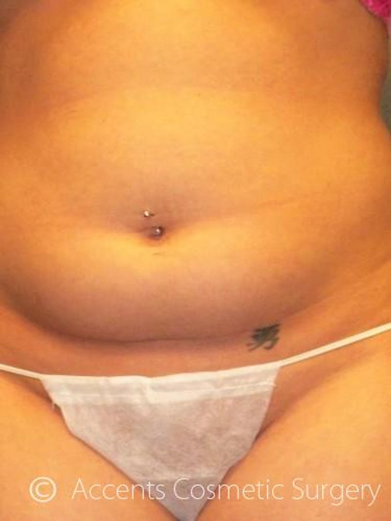Body Jet Smartlipo Before & After Gallery - Patient 111511 - Image 1