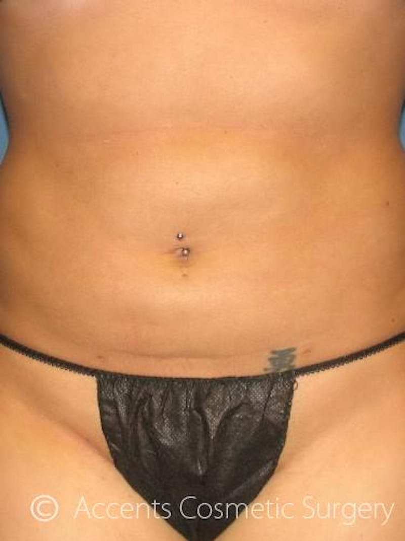 Body Jet Smartlipo Before & After Gallery - Patient 111511 - Image 2