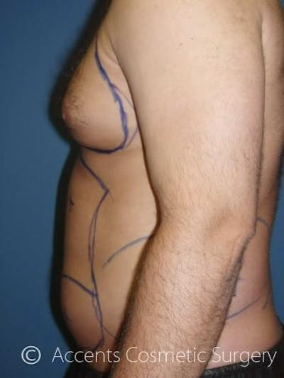 Body Jet Smartlipo Before & After Gallery - Patient 399923 - Image 1
