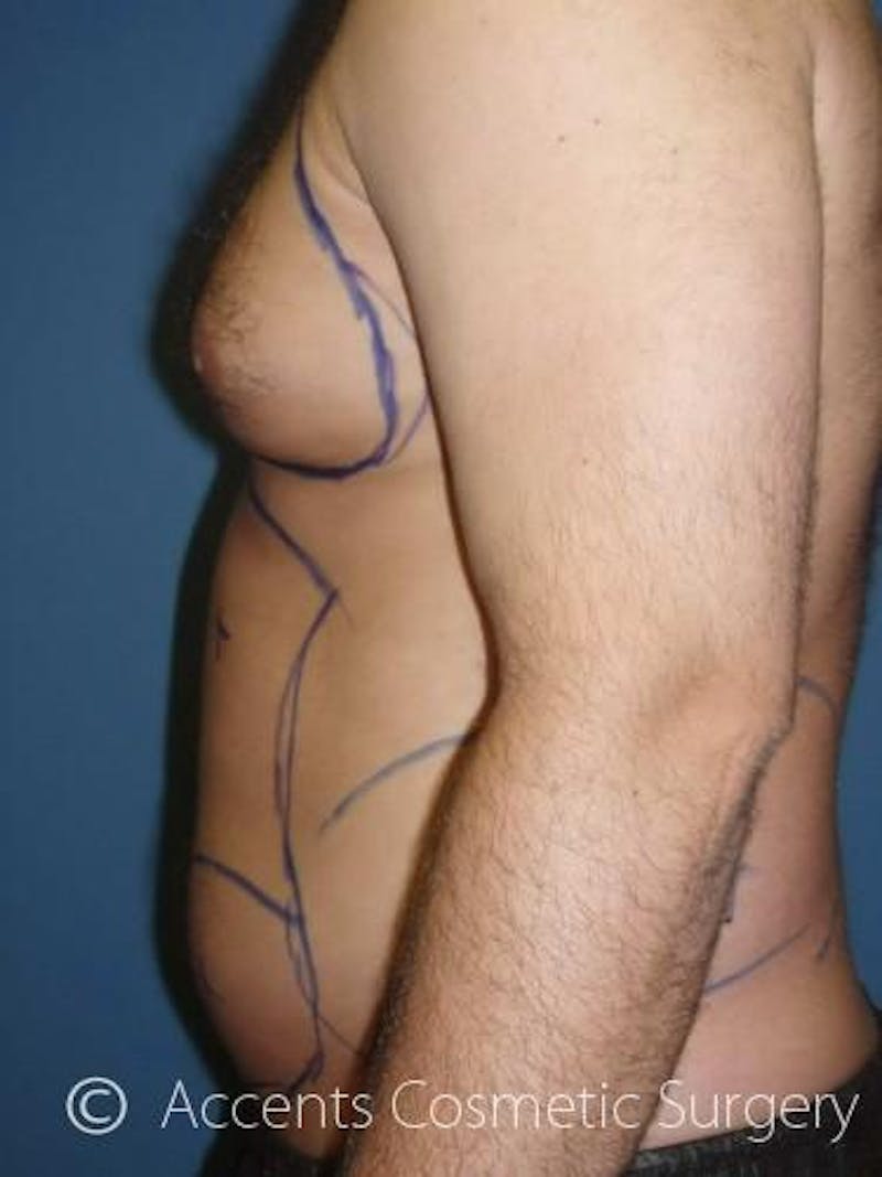 Body Jet Smartlipo Before & After Gallery - Patient 399923 - Image 1