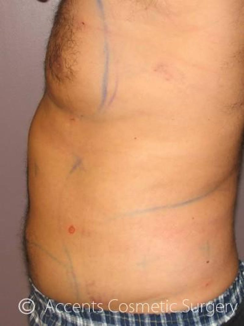 Body Jet Smartlipo Before & After Gallery - Patient 399923 - Image 2