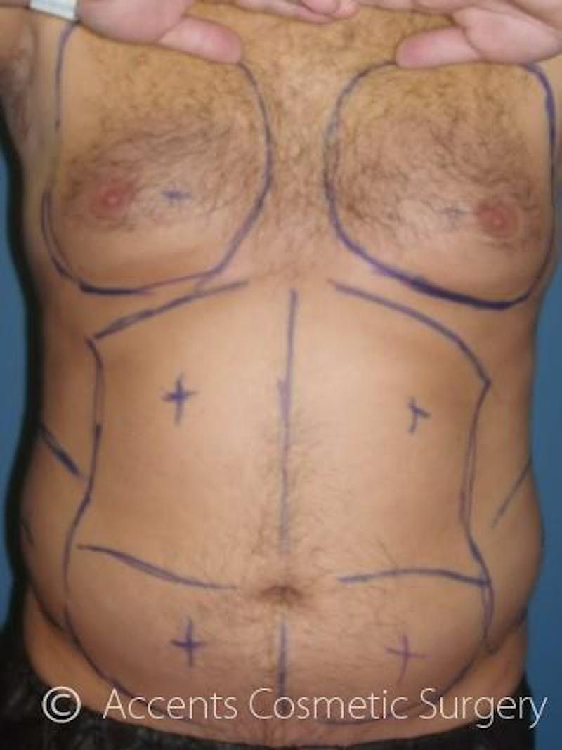 Body Jet Smartlipo Before & After Gallery - Patient 399923 - Image 3