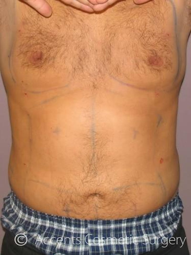 Body Jet Smartlipo Before & After Gallery - Patient 399923 - Image 4
