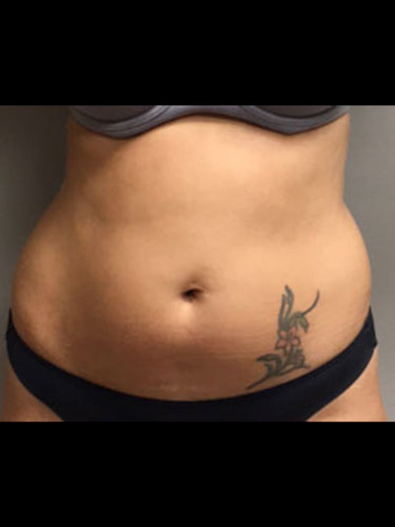 Body Jet Smartlipo Before & After Gallery - Patient 421087 - Image 1