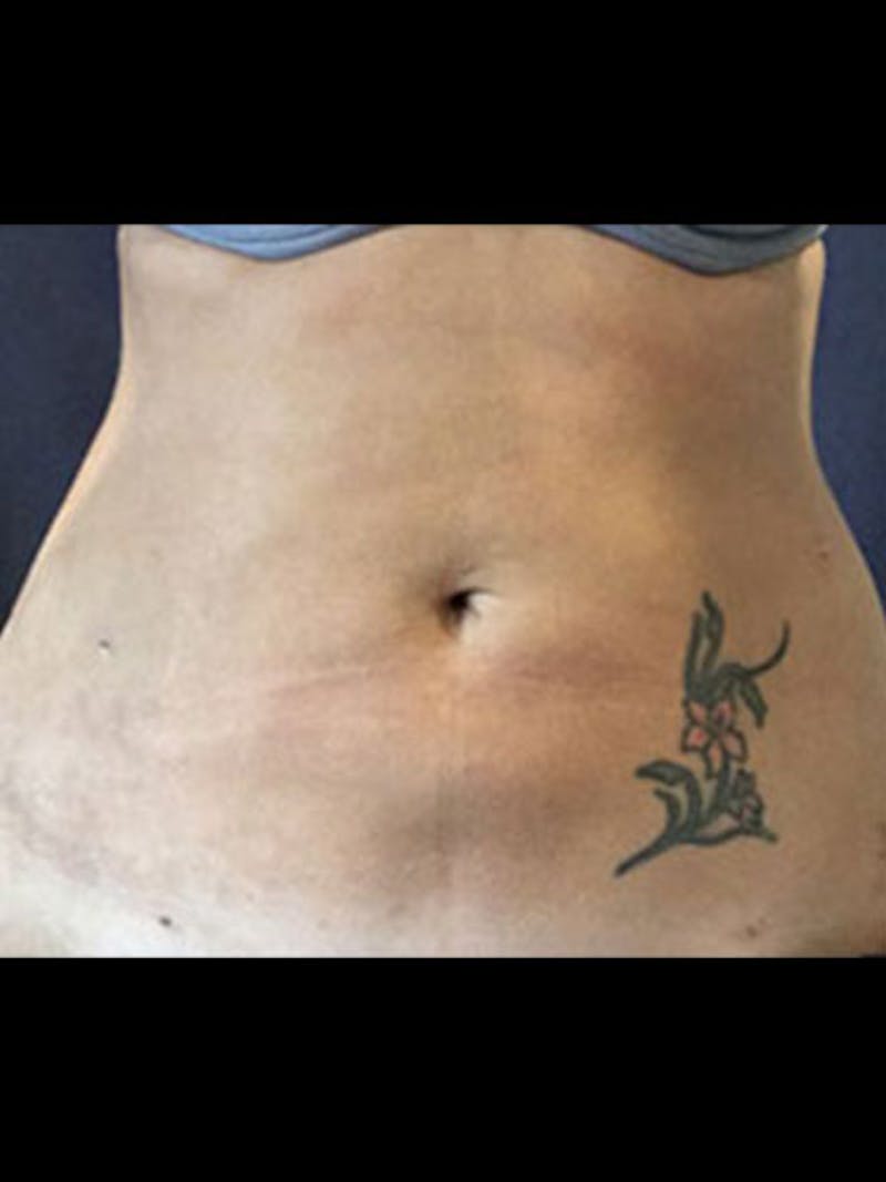 Body Jet Smartlipo Before & After Gallery - Patient 421087 - Image 2