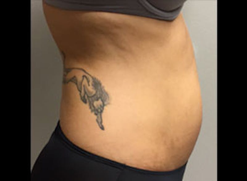 Body Jet Smartlipo Before & After Gallery - Patient 421087 - Image 3