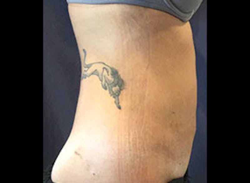 Body Jet Smartlipo Before & After Gallery - Patient 421087 - Image 4