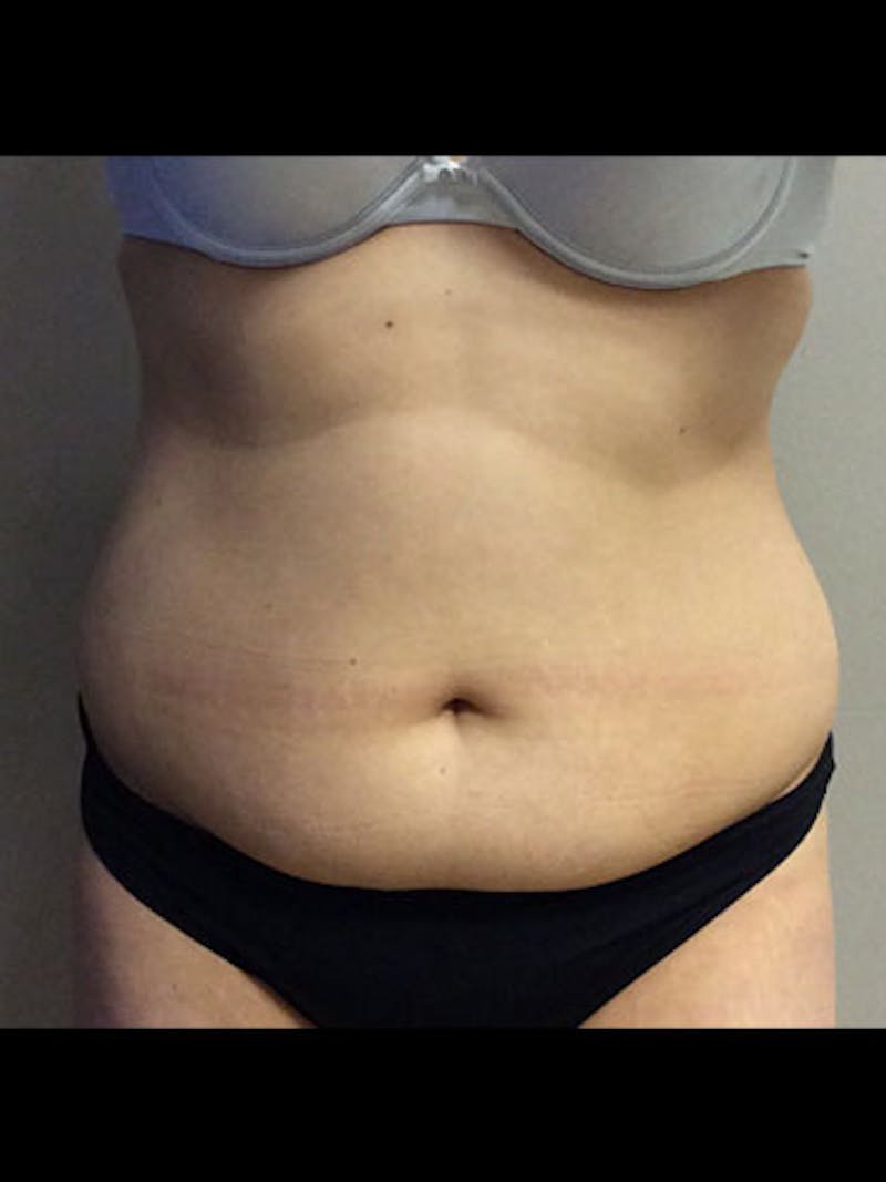 Body Jet Smartlipo Before & After Gallery - Patient 469424 - Image 1
