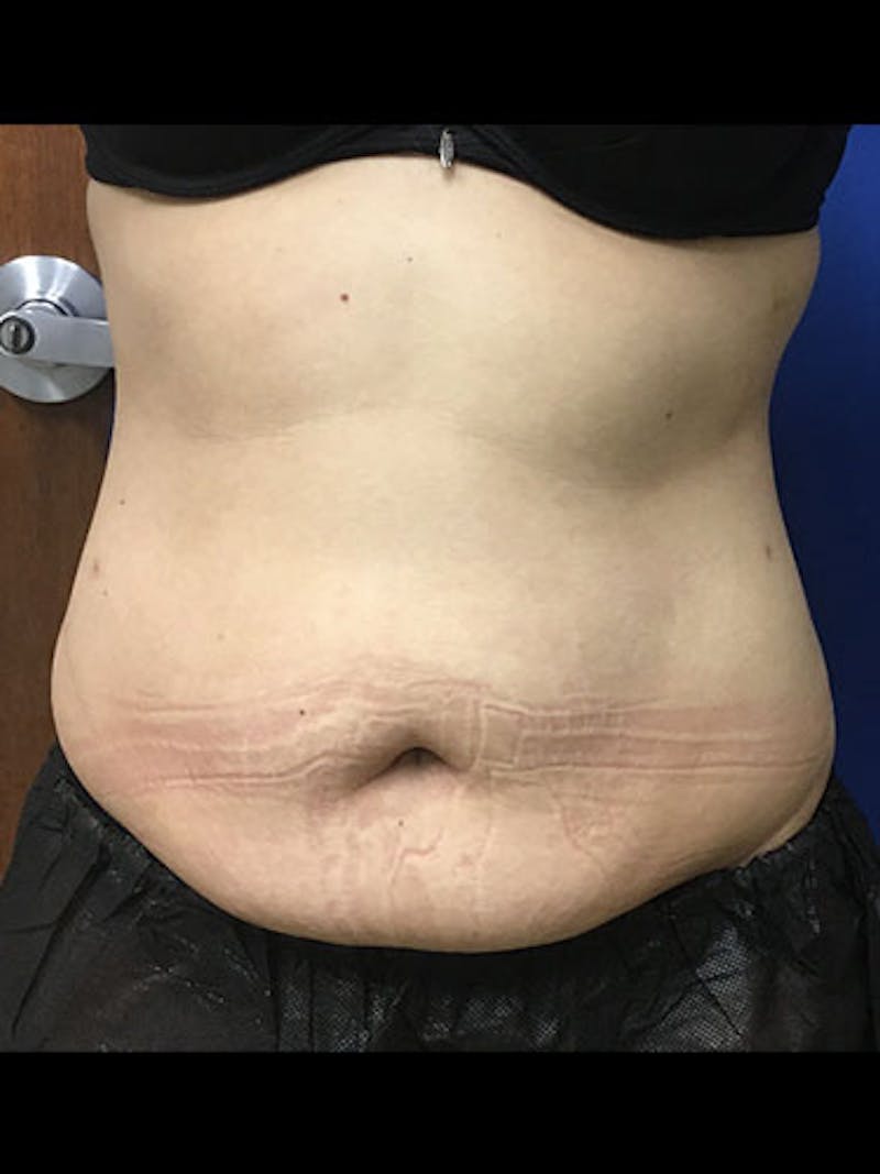 Body Jet Smartlipo Before & After Gallery - Patient 469424 - Image 2
