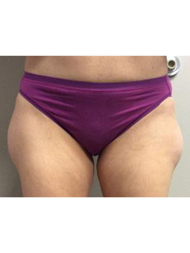 Body Jet Smartlipo Before & After Gallery - Patient 114816 - Image 1