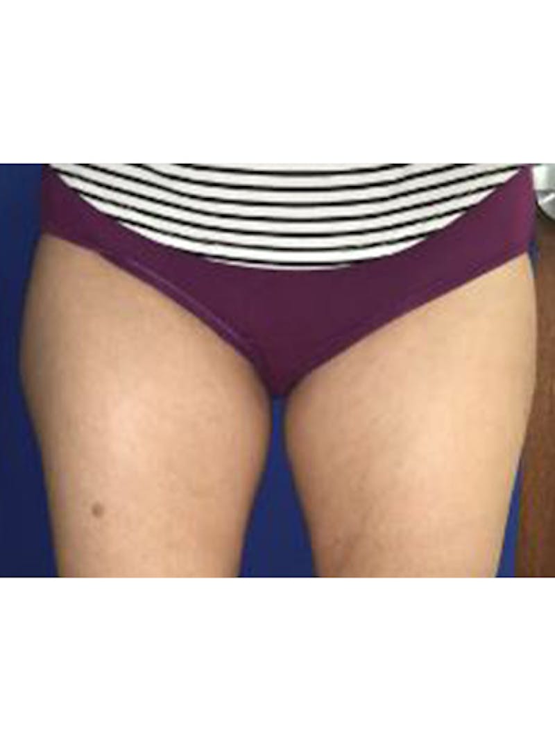 Body Jet Smartlipo Before & After Gallery - Patient 114816 - Image 2