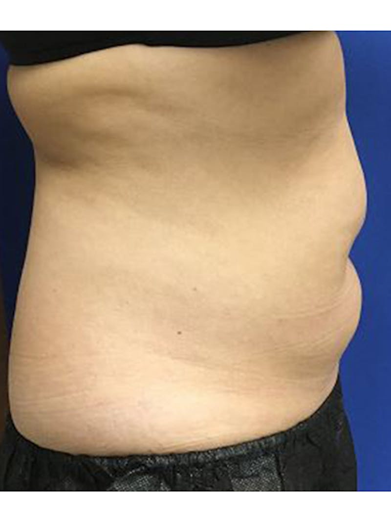Body Jet Smartlipo Before & After Gallery - Patient 196101 - Image 1