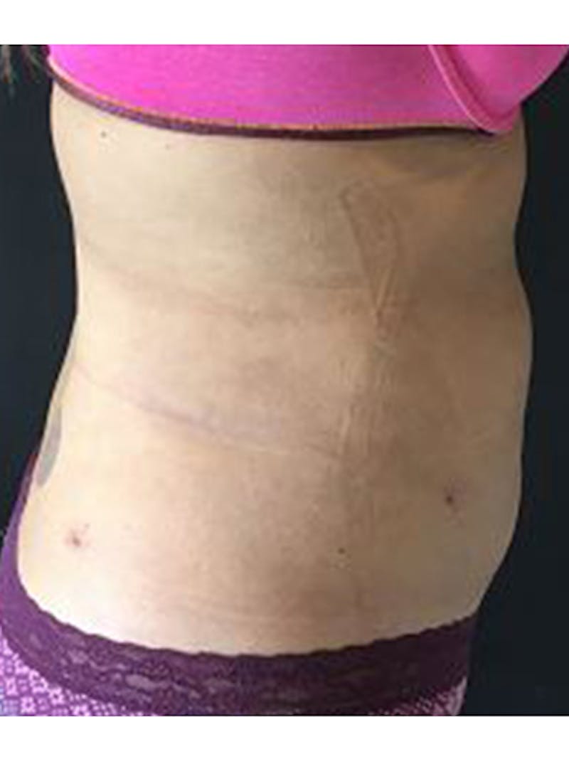 Body Jet Smartlipo Before & After Gallery - Patient 196101 - Image 2