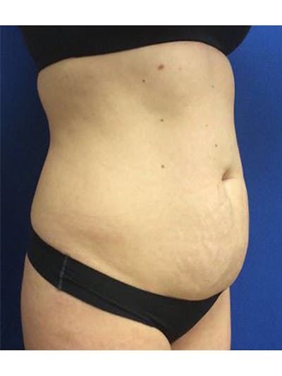 Body Jet Smartlipo Before & After Gallery - Patient 427351 - Image 1