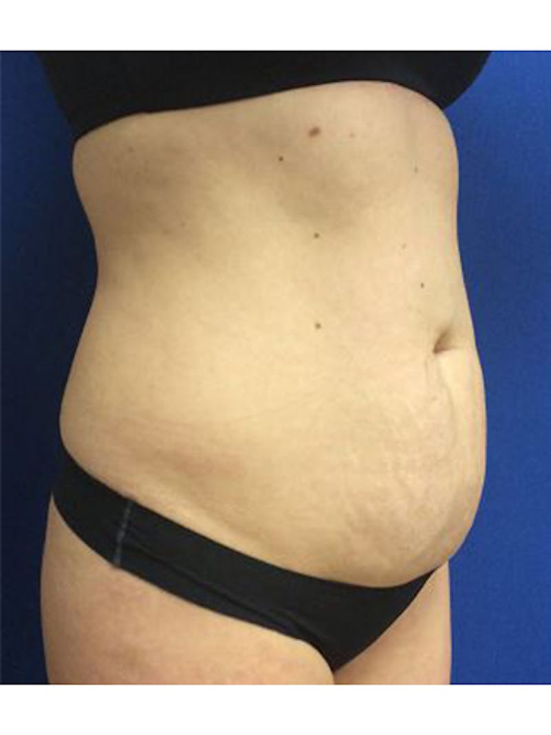 Body Jet Smartlipo Before & After Gallery - Patient 427351 - Image 1