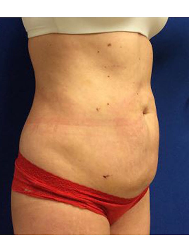 Body Jet Smartlipo Before & After Gallery - Patient 427351 - Image 2