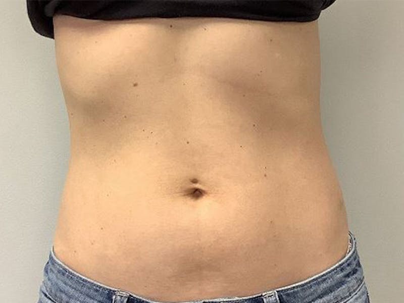 Emsculpt Neo Before & After Gallery - Patient 414155 - Image 1