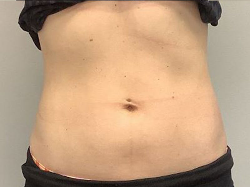 Emsculpt Neo Before & After Gallery - Patient 414155 - Image 2