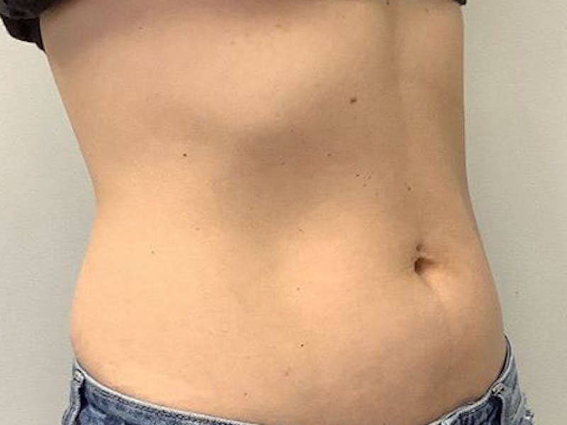 Emsculpt Neo Before & After Gallery - Patient 414155 - Image 3