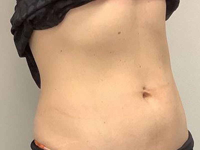 Emsculpt Neo Before & After Gallery - Patient 414155 - Image 4