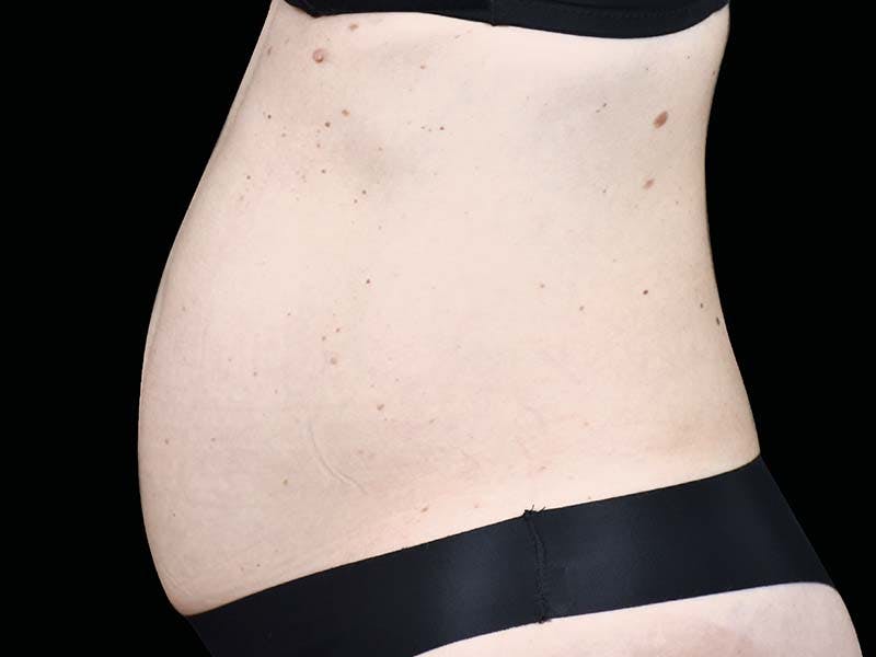 Emsculpt Neo Before & After Gallery - Patient 403872 - Image 1