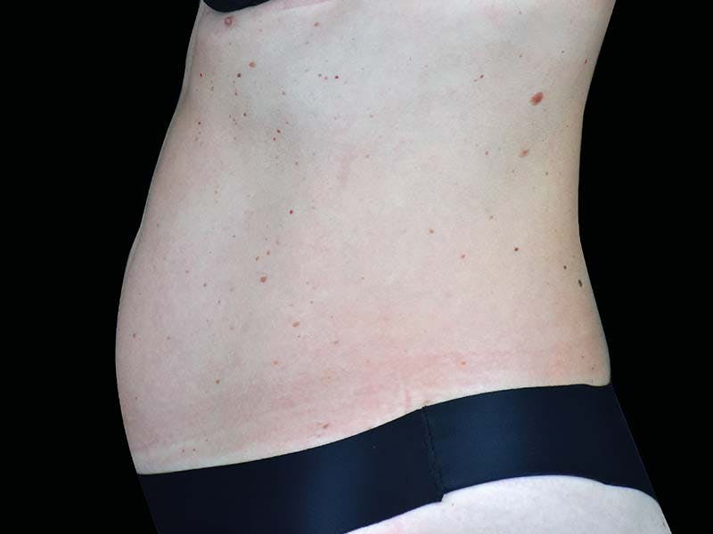 Emsculpt Neo Before & After Gallery - Patient 403872 - Image 2