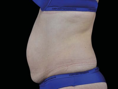 Emsculpt Neo Before & After Gallery - Patient 265019 - Image 1